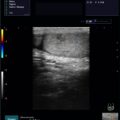 Echo-Son / ALBIT- Uniwersalny ultrasonograf / przykładowe obrazy / LA510/ urologia