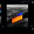 Echo-Son / ALBIT ultrasound scanner/ Images gallery / LA510 /Colour Doppler