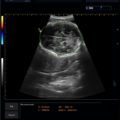 Echo-Son / ALBIT- Uniwersalny ultrasonograf / przykładowe obrazy / CA255 / pomiar HC