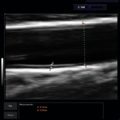 Echo-Son / ALBIT ultrasound scanner/ Images gallery / LA510 / IMT measurement