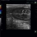 Echo-Son / ALBIT ultrasound scanner/ Images gallery/LA510