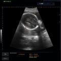 Echo-Son / ALBIT- Uniwersalny ultrasonograf / przykładowe obrazy / CA255 / pomiar BPD