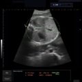 Echo-Son / ALBIT- Uniwersalny ultrasonograf / przykładowe obrazy / CA255 / pomiar AC