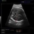 Echo-Son / ALBIT ultrasound scanner/ Images gallery / Ca255 / BPD measurement