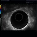 Echo-Son / ALBIT- Uniwersalny ultrasonograf / przykładowe obrazy / colorectal R510/balon wodny