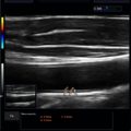 Echo-Son / ALBIT- Uniwersalny ultrasonograf / przykładowe obrazy / LA510 / pomiar IMT