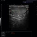 Echo-Son / ALBIT ultrasound scanner/ Images gallery / LA510 /urology