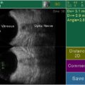 Echo-Son / PIROP ophthalmic ultrasound / B-scan / B+B mode