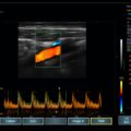 Echo-Son /EPIDOT - ultrasonograf przenośny/LA510 / PW+Color Dopplerraf przenośny/LA510 / PW+Color Doppler