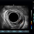Echo-Son /EPIDOT - ultrasonograf przenośny/R510/Colorectal