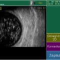 Echo-Son / PIROP ophthalmic ultrasound / B-scan /