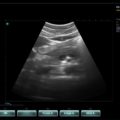 Echo-Son / SPINEL ultrasound scanner / CA255 /