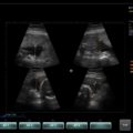 Echo-Son / Ultrasonograf SPINEL / CA255 / tryb 4B