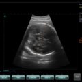 Echo-Son / SPINEL ultrasound scanner / CA255 / BPD calculation
