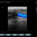Echo-Son / SPINEL ultrasound scanner / LA510 /Color Doppler