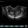 Echo-Son / SPINEL ultrasound scanner / 2R575