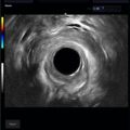 Echo-Son / ALBIT- Uniwersalny ultrasonograf / przykładowe obrazy / colorectal R510