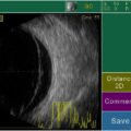 Echo-Son / PIROP ophthalmic ultrasound / B-scan /
